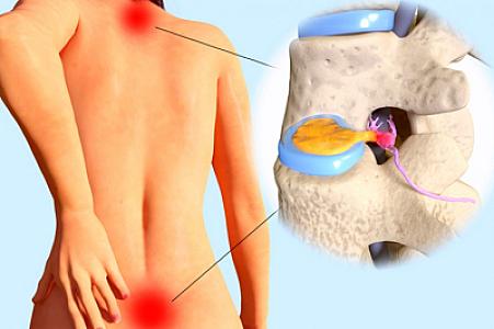 Fəqərəarası disk yırtıqları nə zaman