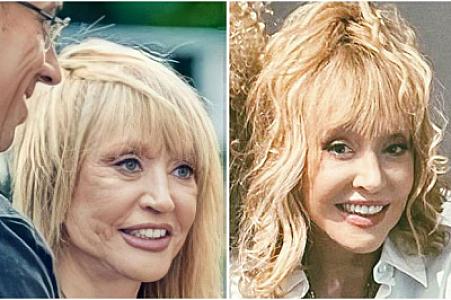 Plastik cərrah: “Alla Puqaçova bütün bədən nahiyələrində