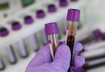 Yüz yaşdan yuxarı insanların qan testlərində 12 mühüm əlamət aşkarlanıb