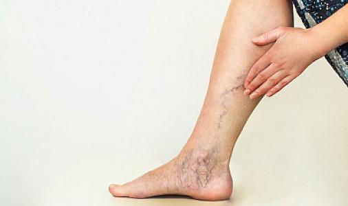 Həkim varikoz damarlarının qarşısını almağın