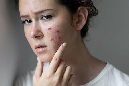 Üzdə dəri töküntüsü hansı xəstəliklərdən