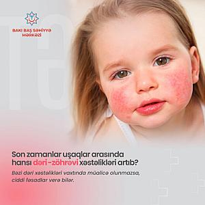 Şöbə müdiri: “Son zamanlar uşaqlar arasında bəzi dəri xəstəlikləri artıb”