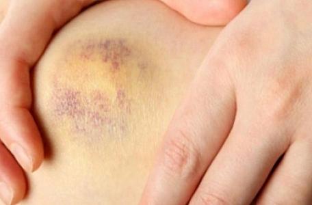 Qançırlar niyə qeyri-müəyyən səbəblərdən yaranır?