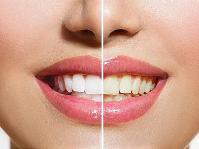 Dişlərimiz niyə saralır? - Türkiyəli həkimdən məsləhət