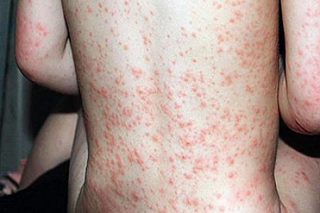 Azərbaycan dünyada qızılcaya ən çox yoluxma olan ölkələr