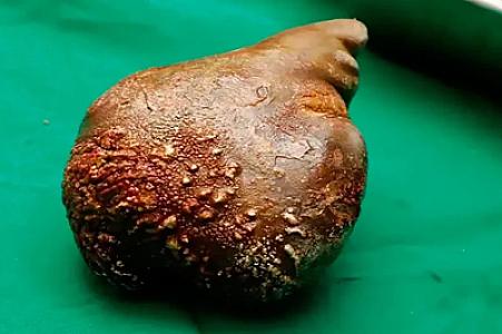 İnsan böyrəyindən çıxarılan ən böyük daş: