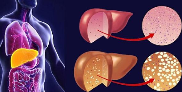 Qaraciyər piylənməsinin
