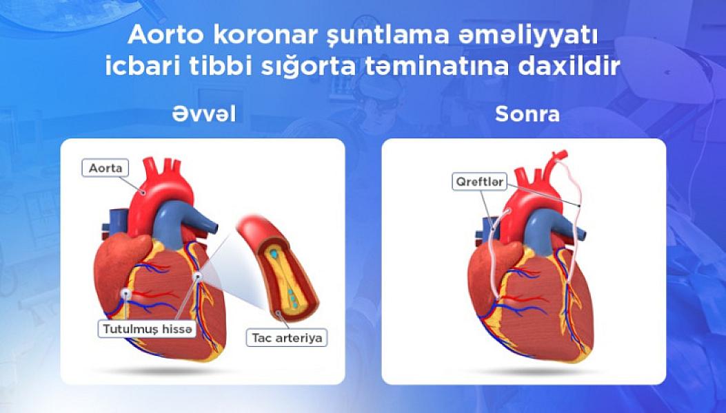 Aorto-koronar şuntlama əməliyyatı icbari tibbi sığorta ilə