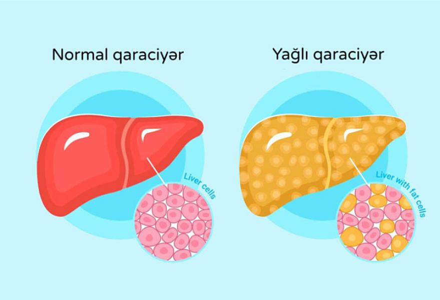 Araşdırma: İnsanın çöhrəsi qaraciyərdə olan xəstəliklərin əlamətlərini göstərə bilər