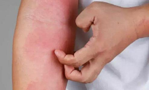 Gecə qəflətən başlayan qaşıntı nəyə işarədir?