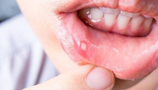 Stomatiti bir gecədə sağaldan