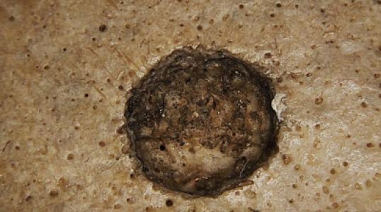 Xərçəngin müalicəsinə ilk cəhd 4 min il əvvəl edilib