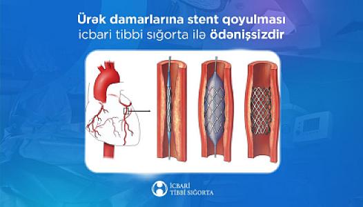 Ürək damarlarına stent qoyulması icbari tibbi sığorta ilə ödənişsizdir?