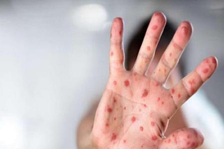 Ötən il 13 mindən çox qızılcaya yoluxma qeydə alınıb