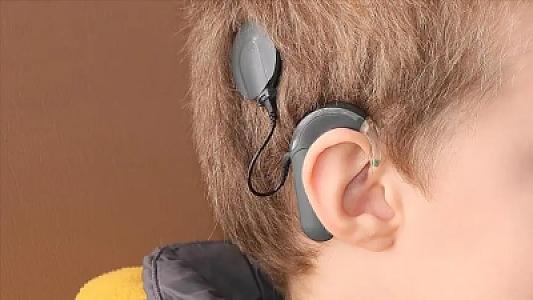 Çində eşitmə qüsurlu 5 uşaq "heyrətləndirici" terapiya ilə