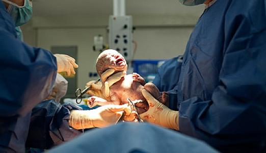 Səbəbsiz qeysəriyyə əməliyyatları: Bu üsulla ana olanların sayı niyə