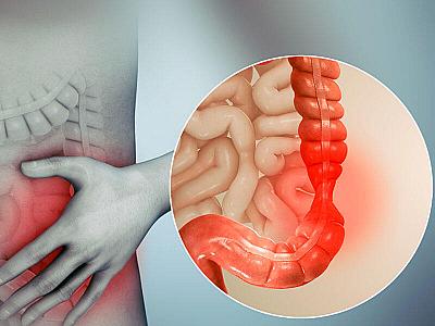 Bu əlamətlər varsa, bağırsaq xərçəngindən şübhələnməlisiniz -