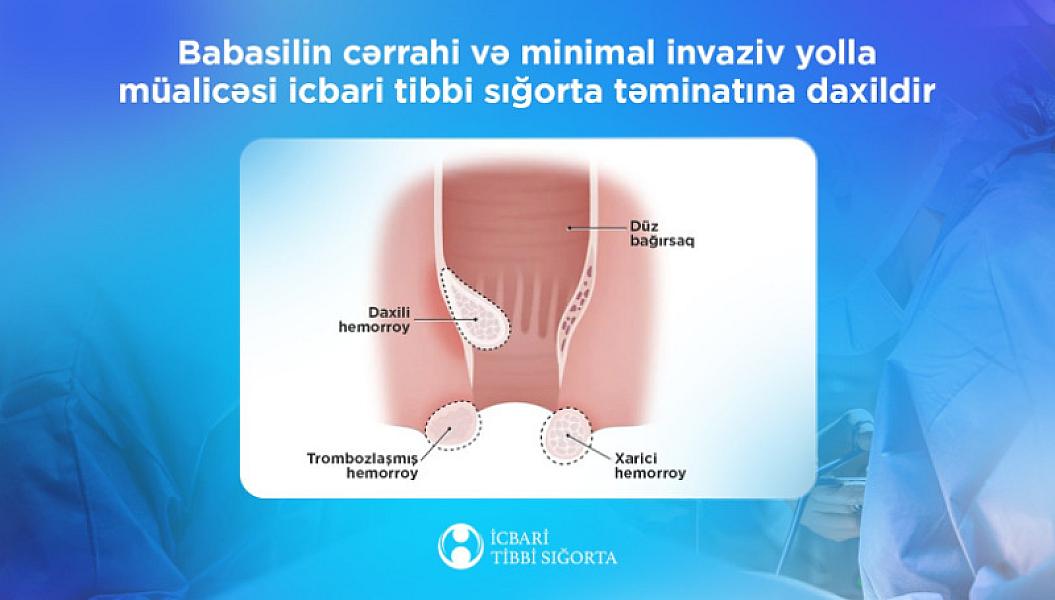 İcbari tibbi sığorta ilə babasilin müalicəsi