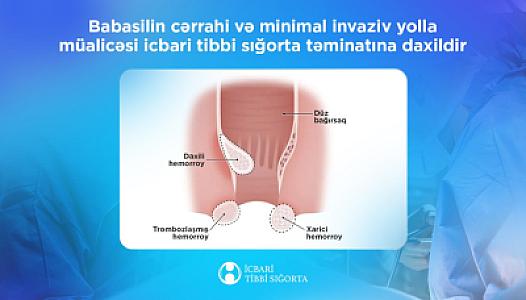 İcbari tibbi sığorta ilə babasilin müalicəsi