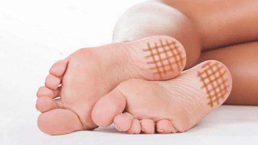 Dabanlara yod çəkmək nəyə faydalıdır?