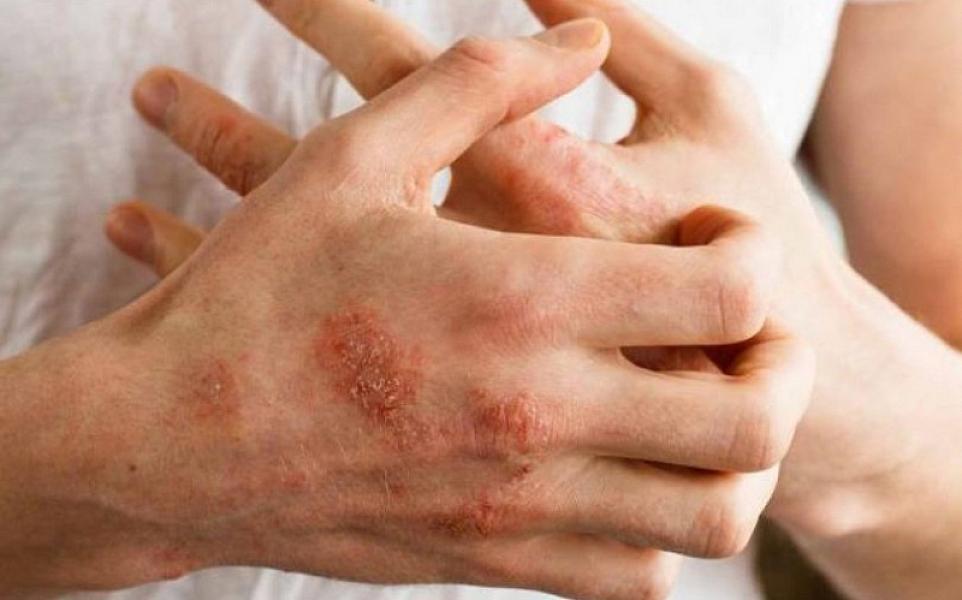 Azərbaycanda ixtioz xəstələrinin sayı açıqlanıb