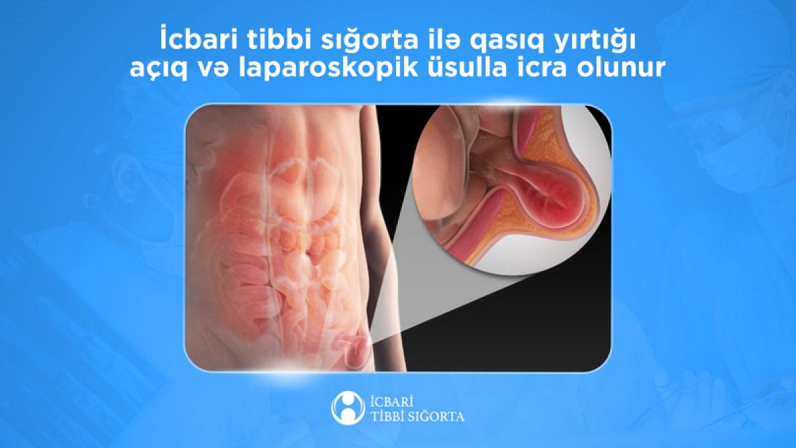 İcbari tibbi sığorta ilə qasıq yırtığı açıq və laparoskopik üsulla