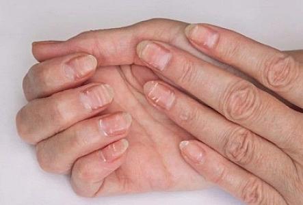 Dırnaqlarınızda ağ ləkələr varsa... –