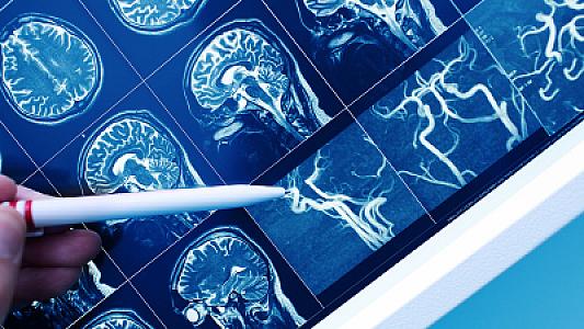 Alimlər yeni neyronların yaradılması üçün