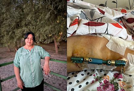 Lift qəzası nəticəsində xəsarət alan qadının