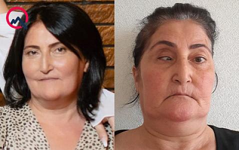 Burun əməliyyatına girən qadının gözündə