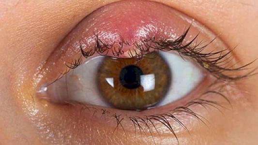 İtdirsəyi çıxan zaman nə etmək lazımdır?