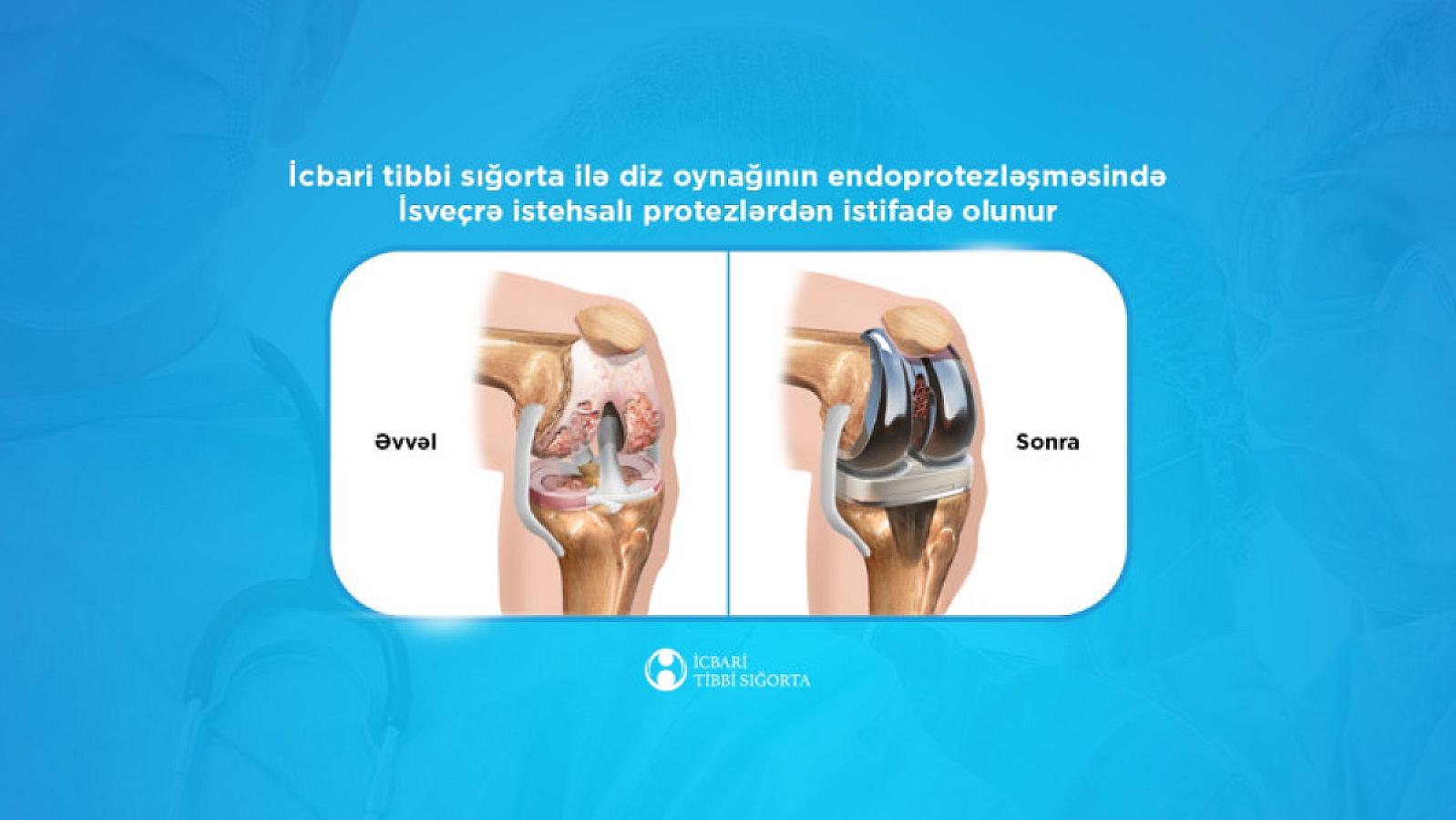 İcbari tibbi sığorta ilə diz oynağının endoprotezləşməsində