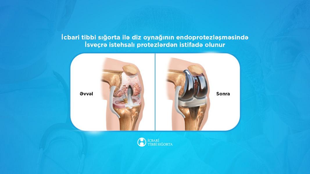 İcbari tibbi sığorta ilə diz oynağının endoprotezləşməsində
