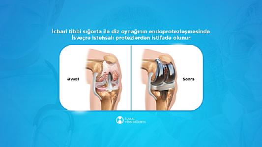 İcbari tibbi sığorta ilə diz oynağının endoprotezləşməsində