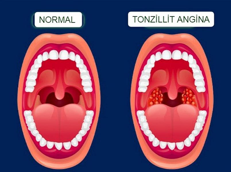 Boğazda çirk yığılmasının səbəbləri və müalicəsi - TONZİLLİT ANGİNA