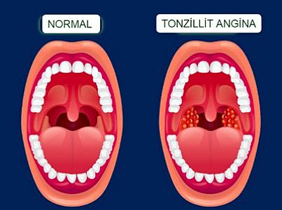 Boğazda çirk yığılmasının səbəbləri və müalicəsi - TONZİLLİT ANGİNA