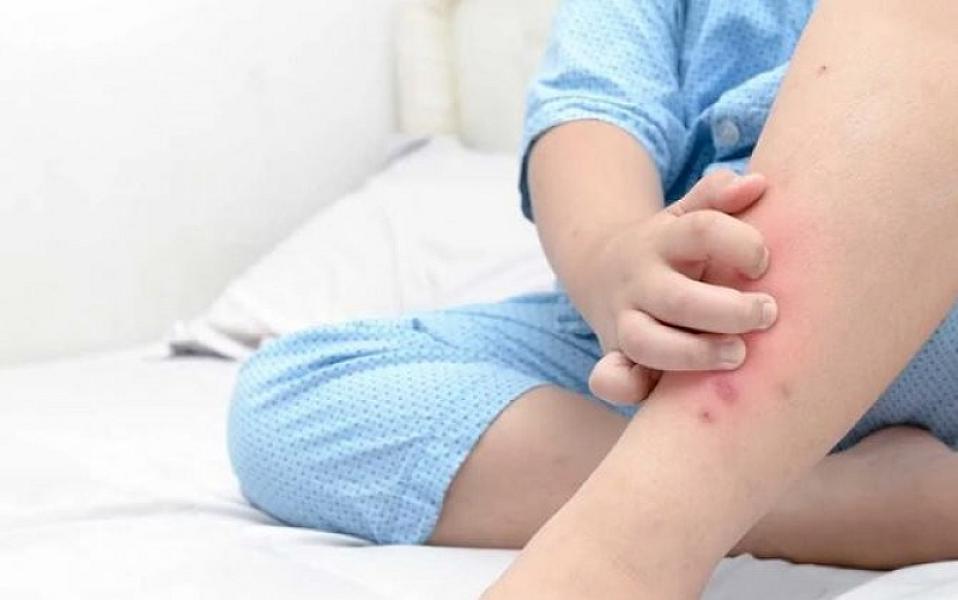 Niyə ağcaqanadlar sizi başqalarından daha tez dişləyir? –