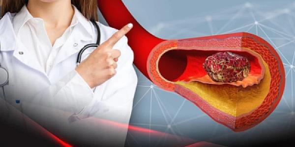 Trombların əmələ gəlməsinin qarşısını almaq üçün