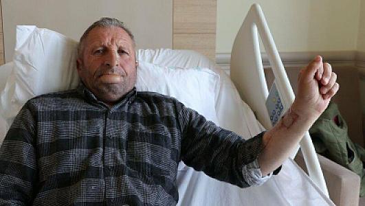 Qol dərisindən dodaq düzəltdilər