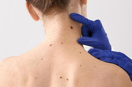 Kim daha çox dəri xərçənginin inkişaf riski altındadır?