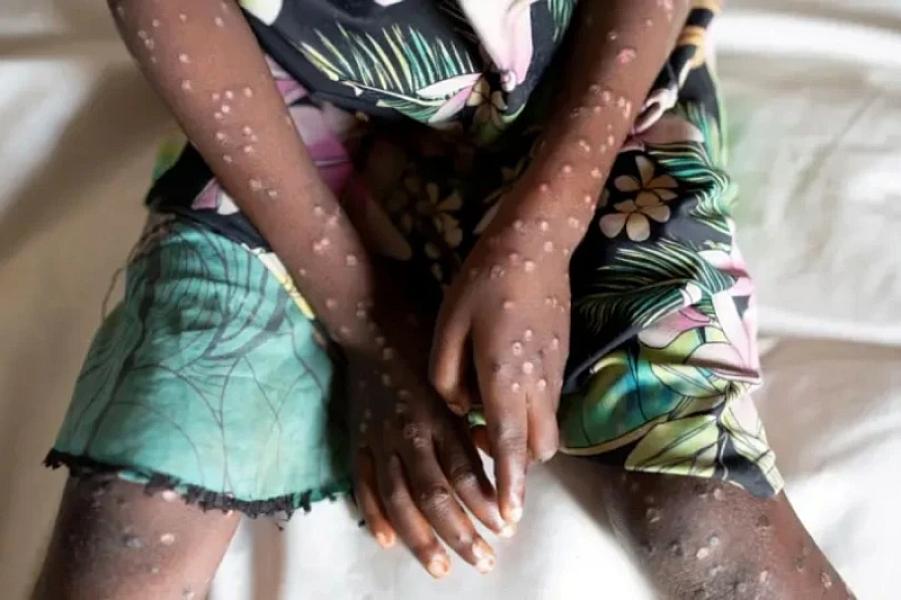 Konqoda meymunçiçəyi epidemiyası: