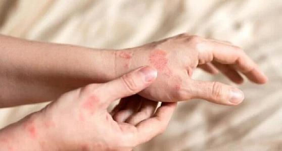 Dəri xəstəliklərinin müalicəsinə müsbət təsir edən