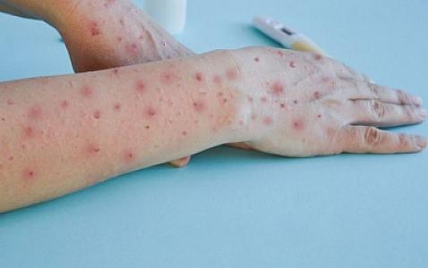 Türkiyədə meymunçiçəyinə