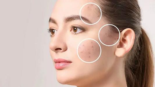 Günəş ləkələrini təmizləmək üçün