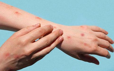 Türkiyədə meymunçiçəyi xəstəliyi ilə bağlı