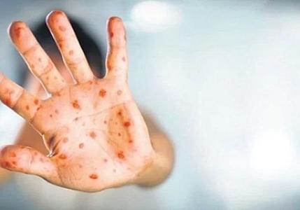 Nə suçiçəyidir, nə də koronavirus: Dünyada sürətlə yayılan meymunçiçəyinə