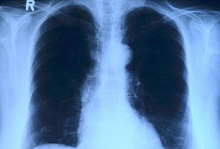 Ağciyəriniz sağlamdırmı? – Özünüz sadə testlə yoxlayın