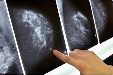 Süd vəzi xərçəngi ilə kəpək arasında