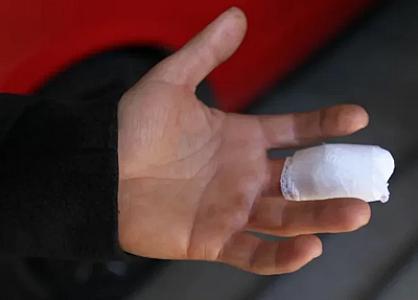 Tanımadığı şəxs barmağını dişlədi, bir müddət sonra öldü -