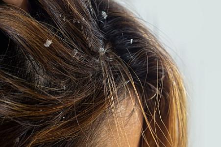 Kəpəklə təbii üsullarla da mübarizə